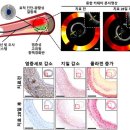 빛을 이용한 심장 혈관내 치료기술개발 이미지