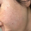 릴리의 생활공장 | 신논현역피부과 릴리쥬(릴리이드 2cc + 리쥬란힐러 2cc)받은 후기(엠보,통증,가격,효과)