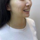 턱끝필러 후기 VS 무턱교정 전후 모르면 손해