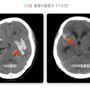뇌졸중 이미지