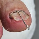 레푸스 | 오창내성발톱 다른곳과 달랐던 레푸스 후기