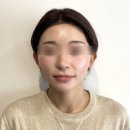 페이스성형외과의원 | 강남 실리프팅 후기 솔직 정리, 일상생활 복귀와 멍 현실은 이렇습니다