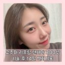 로데오사우나 | 압구정로데오역 피부과 텐써마300샷 리얼 후기 고현정 리프팅 2주 턱 라인 변화