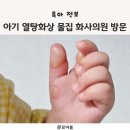 화사의원 | [아기 화상] 10개월 열탕화상 응급처치 안 함 물집 잡혀 화사 의원 방문