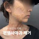 차오름약국 | 편평사마귀 레이저 제거 후기 | 당일~18일차 회복 기록 딱지 흉터 패임 연고 관리법