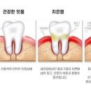 치주 질환 증상: 원인과 전신 질환 유발 연관성 (치주 질환과 침 타액의 항균 효능) 이미지