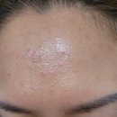 신논현비비약국 | 논현동 시네마의원 리쥬란힐러4cc 💉💉2회차!! 내돈내산 솔직후기