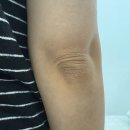 여름맞이 팔꿈치 멜라닌케어 봉명동 더미미 방문후기