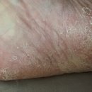 메디원스 | 약국 라미실원스 가격 1회 무좀약 추천 사용방법