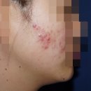 내포한의원 | 안산 중앙동여드름한의원 한약을 사용한다면