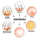 용담한의원 | 방풍통성산가미방을 병행한 지루성 피부염 치험 1례