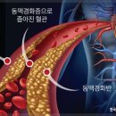 뜻밖의 돌연사(突然死) 증상 이미지