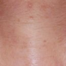 청담청초성형외과의원 | 근육고정 앞트임 수술 방법- 청담청초 성형외과