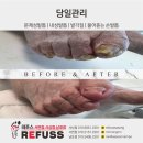레푸스 남포점 네일포시즌 | [레푸스 남포점] 거동안되고 요양원에 계시는 80대 남성 발톱무좀관리 받은 후기