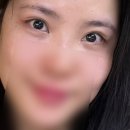 메디큐브의원 | [내돈내산]•눈밑지 여우눈 언제쯤 돌아 올까유? 나나 성형외과 눈밑지 2달차 경과 후기!