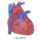 오래된 만성 심근경색증(Old myocardial infarction) 이미지