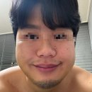 코퍼쌤 | [양악수술 후기] 5편 : 수술 후 일주일(7일차) 붓기 경과 및 외래 진료