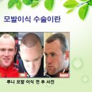 더모헤어플란트 미지예피부과
