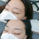 어려진의원 | 강남 자연눈썹 아프지 않게 눈썹잘하는 곳, 리앤시뷰티