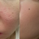 [패인흉터 극복기] 여자 얼굴 여드름흉터 패인흉터 치료기