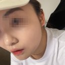 디자인300 | 울쎄라 효과 300샷 후기 통증부터 턱선 변화까지