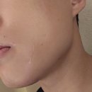 남자수염 레이저제모, 점빼기 부평역 톤즈의원인천본점 젠틀맥스프로 내돈내산 솔직후기