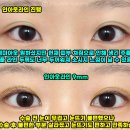 JT빌딩 | 신사 자연유착 인아웃라인 9미리 전후사진 후기