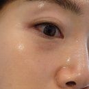 아그네스 | 한관종 제거 후기 아그네스 2차, 쥬베룩 유지기간
