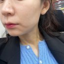 박성주조에피부과의원 | 검단피부과 스킨부스터 시술 리제반힐러 2cc 후기