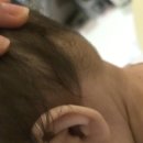 뒤통수 | 아기 머리 뒤통수 혹, 초음파 검사 후기 (임파선? 피지낭종? 진단결과와 비용)