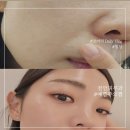 천안 피부과 스킨부스터 필로드 예쁨주의 내돈내산 후기