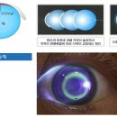 [봄의약속안과]꿈의렌즈라고 불리는 드림렌즈! 안경과 렌즈 없이 다음날 시력교정효과 탁월 ! 드림렌즈란? 이미지