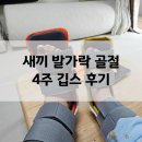 버팀병원 | 새끼발가락 골절 치료 수원 버팀 병원 반깁스 기브스 방수커버 후기