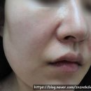 [내돈내산] 지루성 피부염에 도움이 되는 영양제 (피부과 의사추천+유튜버 추천 영양제), 먹는 썬크림...