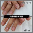 라온네일 호계점 | 안양호계동 물어뜯는 손톱및 문제성 손발톱 관리