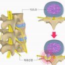 추간판탈출증 요추추간판탈충증 허리디스크 원인 허리디스크 추간판탈출증 보존적 적 이미지