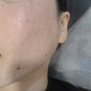 닥터스피부과의원 광주신세계점 | 밴스의원 광주주월점 마취없이 리쥬란 5회차 손주사 후기