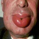 혈관부종 (Angioedema) 이미지