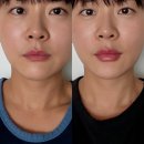 멍,멍# | 레스틸렌 키스로 받은 강남 입술필러 붓기, 멍 등 솔직 후기