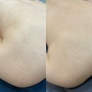새로나침구 - 광진구 아차산로29길 56 | 안양여드름피부과 등드름 열심히 케어받은 1회차 후기