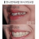 최승호 신경과의원 | 압구정 라미네이트 체크해야 될 1가지?