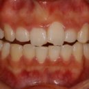 돌출되고 삐뚤어진 치아의 치료 : 치아성형.급속교정.앞니교정. 전문가미백가격.앞니교정비용 이미지