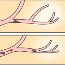 폐 혈전색전증 (Pulmonary Thromboembolism) 이미지