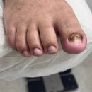 푸스케어 원주점 | 원주내성발톱 푸스케어 원주점 편하게 상담받고 온 후기