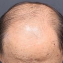 계수초교 | 시흥탈모병원, 60대 후반 중증 탈모 리제네라액티바 3개월차 실제 후기