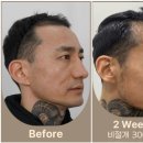 오케이성형외과의원 | 성형외과 전문의가 풀어보는 비절개모발이식 후기