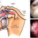 오십견인가 했는데…복합적 어깨질환 조심 이미지