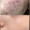 나을약국 | 약국 egf재생크림 새살 연고 유명템 TOP5 비교 후기