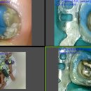 연세화이트치과의원 | 재신경치료 후기 (+연세화이트치과 강서)