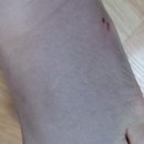 힘센병원 네이버블로그